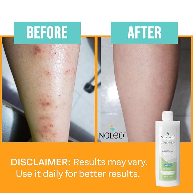 NOLEO Natural Skin Care – Deep Moisturizer for Sensitive Skin | Soothes Redness, Chafing & Irritation | Non-Toxic, EWG Verified, Organic | Face & Body Cream for Adults & Babies – 8oz